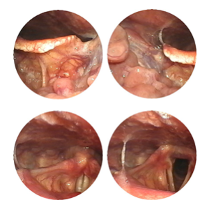 南京耳鼻喉专科医院排名好的仁品医院医生孙高亮 治疗肥厚性咽炎案例1