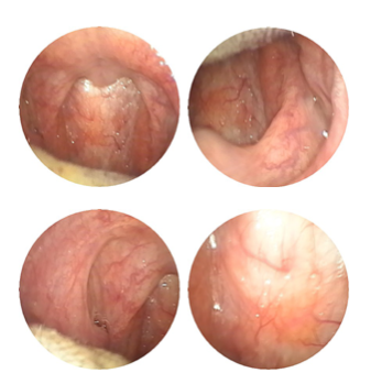 南京耳鼻喉专科医院排名好的仁品医院医生孙高亮 治疗肥厚性咽炎案例