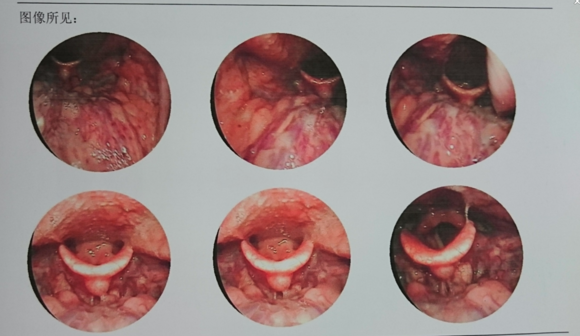 南京仁品耳鼻喉医院王其峰主任诊治慢性咽炎案例1